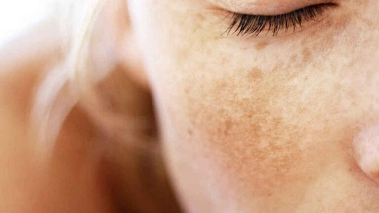 tratamiento del melasma