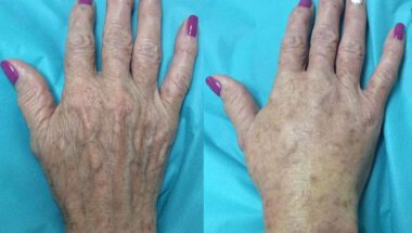 Rejuvenecimeinto de manos por lipotransferencia