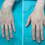 Rejuvenecimiento de manos con lipotransferencia