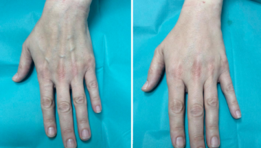 Rejuvenecimiento de manos con lipotransferencia