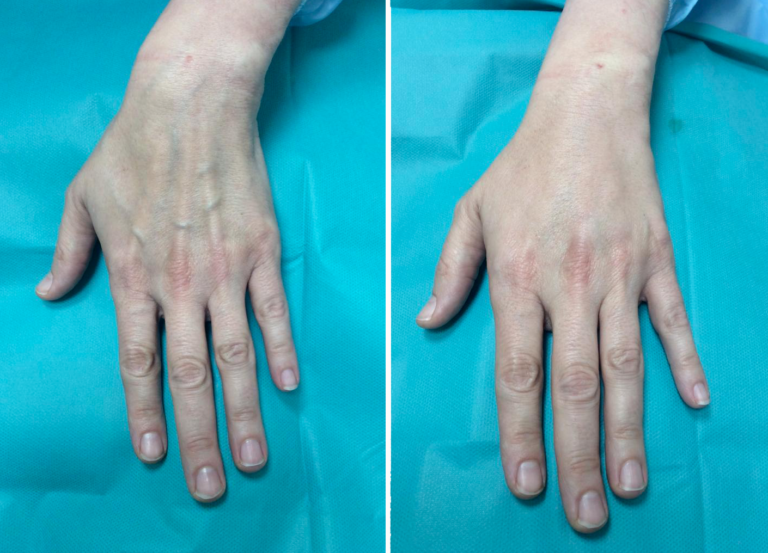 Rejuvenecimiento de manos con lipotransferencia