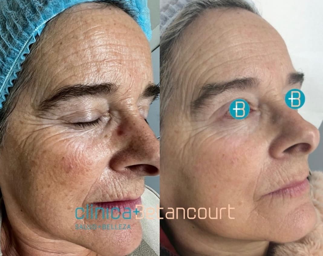 Láser Starwalker FOTONA Remoción de Tatuajes Clínica Betancourt