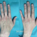Lipotransferencia Madrid