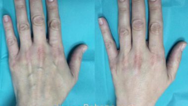Lipotransferencia Madrid