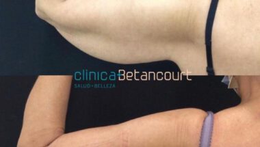 lipolaser-en-los-brazos