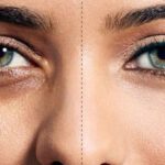 Ojeras Oscuras o Hiperpigmentadas