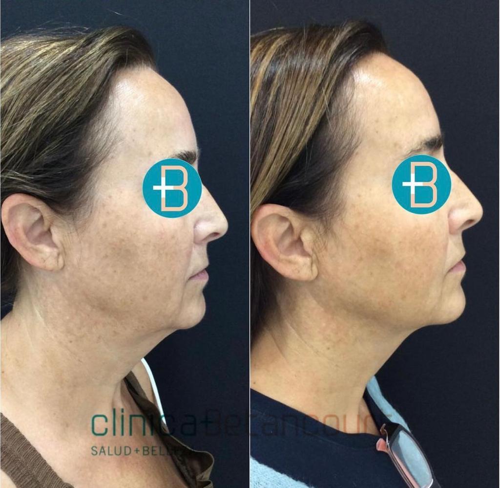 endolifting facial antes y después