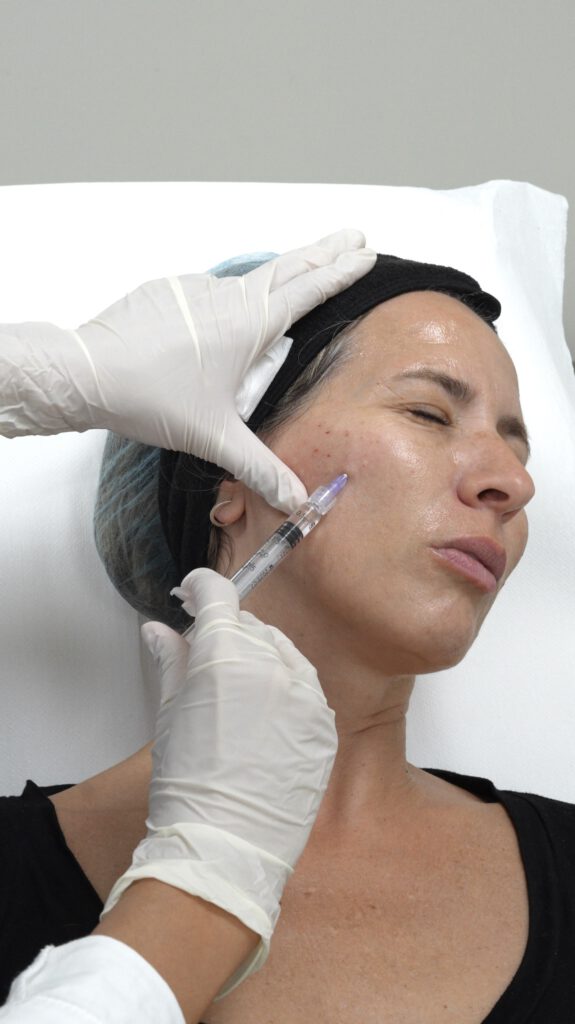 PRP facial para mejorar la piel en verano