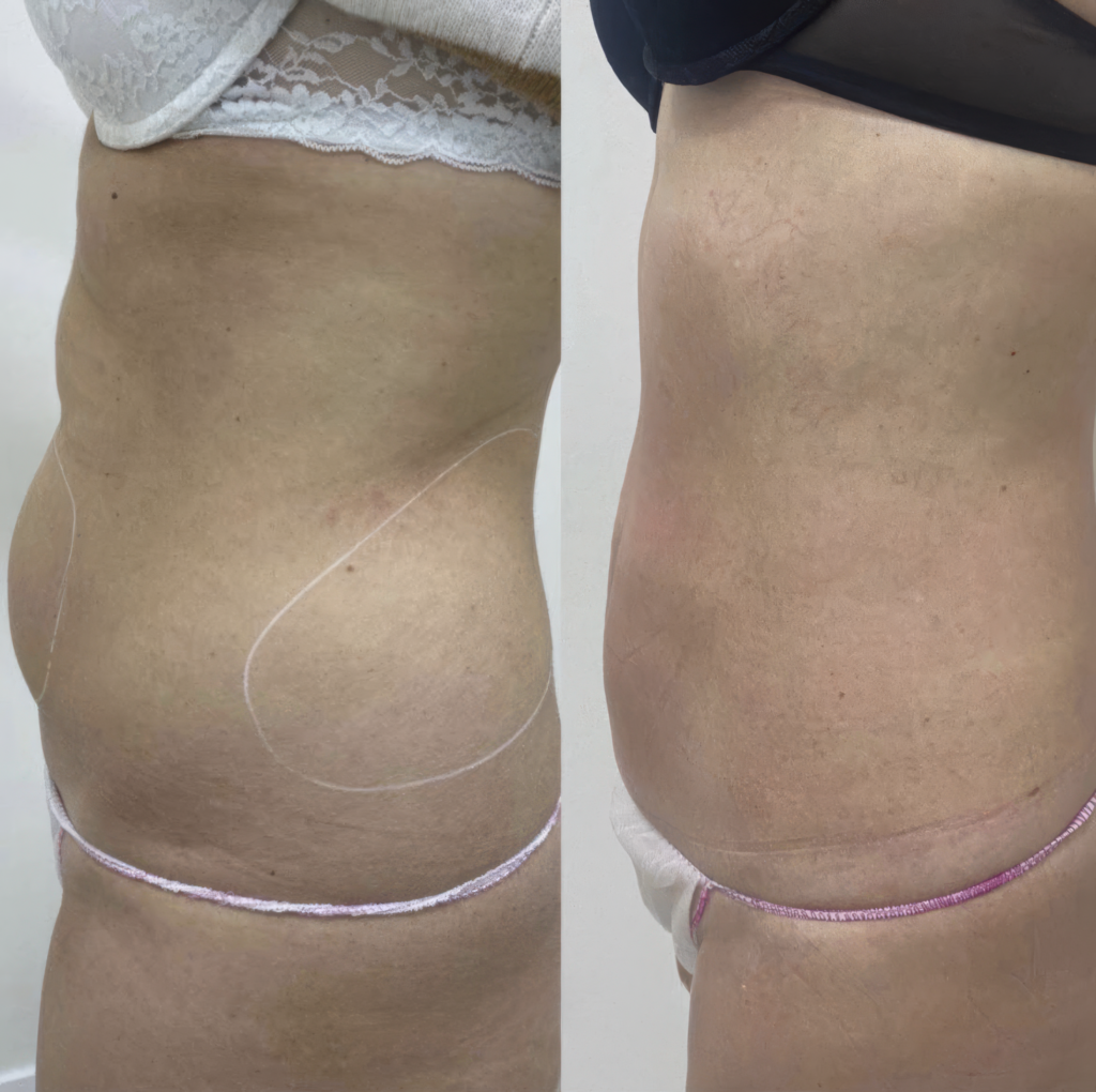 Antes y después criolipólisis, Resultado de tratamiento para eliminar grasa localizada sin cirugía