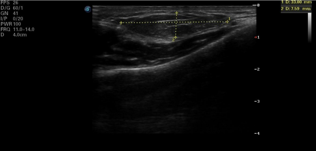 Ecografía de lipoma