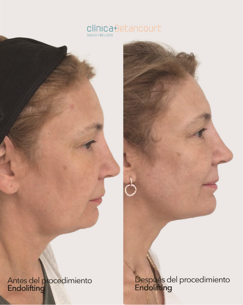Antes y después Endolifting Facial