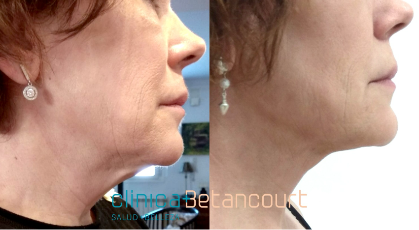 Antes y después Endolifting facial
