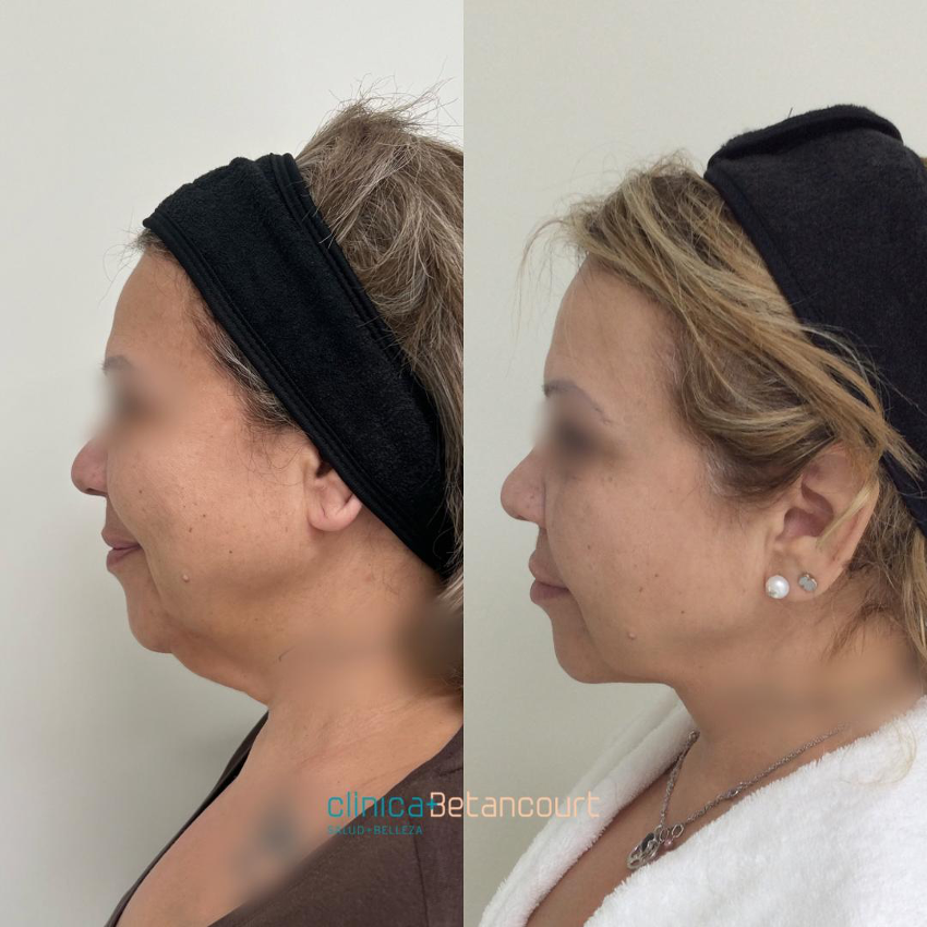Antes y después Endolifting facial